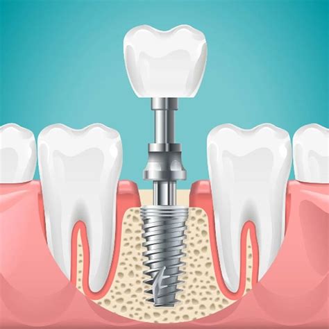 Dental Implants – Dental Clinic.